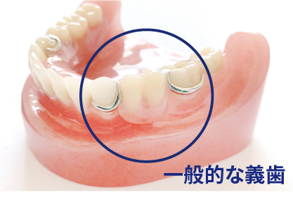 一般的な義歯